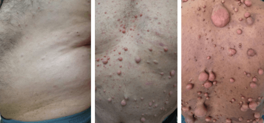 What Is NF1 Disease: A Clear Overview of Causes, Symptoms, and Management